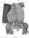 Fig. 125 - Device for releasing spinal contractures and associated methods