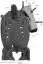 Fig. 130 - Device for releasing spinal contractures and associated methods