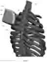 Fig. 131 - Device for releasing spinal contractures and associated methods