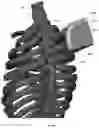 Fig. 136 - Device for releasing spinal contractures and associated methods
