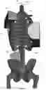 Fig. 137 - Device for releasing spinal contractures and associated methods