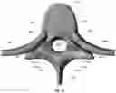 Fig. 14 - Device for releasing spinal contractures and associated methods