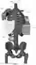 Fig. 141 - Device for releasing spinal contractures and associated methods
