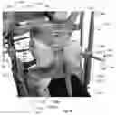 Fig. 75 - Device for releasing spinal contractures and associated methods
