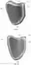 Fig. 90 - Device for releasing spinal contractures and associated methods