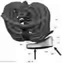 Fig. 95 - Device for releasing spinal contractures and associated methods