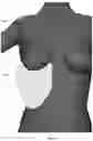 Fig. 99 - Device for releasing spinal contractures and associated methods