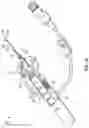 Fig. 02 - TELESCOPING NEEDLE SHIELD WITH BLOOD EXPOSURE PREVENTION