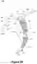 Fig. 04 - TRACHEAL TUBE AND SUCTION DEVICE