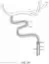 Fig. 04 - Rapid aspiration thrombectomy system and method