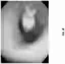 Fig. 41 - Electrospray catheter