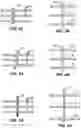 Fig. 05 - Device and method for compartmental vessel treatment