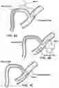 Fig. 05 - DEVICES AND METHODS FOR ALLEVIATING LYMPHATIC SYSTEM CONGESTION