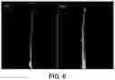 Fig. 07 - DEVICES AND METHODS FOR ALLEVIATING LYMPHATIC SYSTEM CONGESTION