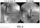 Fig. 13 - DEVICES AND METHODS FOR ALLEVIATING LYMPHATIC SYSTEM CONGESTION