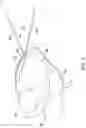 Fig. 06 - Implantable medical devices and methods for making and delivering implantable medical devices