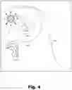 Fig. 05 - Systems and methods for facilitating optimal alignment of cochlear implant system components