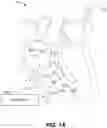 Fig. 02 - Terminating pacemaker mediated tachycardia (PMT) in dual chamber leadless pacemaker systems