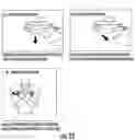 Fig. 33 - METHOD FOR REDUCING TENSION IN MUSCLES OF THE HUMAN BODY BY NEUROHEMATOLOGIC DIVERSION
