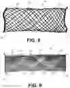 Fig. 07 - Braided medical devices