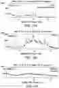 Fig. 57 - Solid forms comprising (s)-4-(4-(4-(((2-(2,6-dioxopiperidin-3-yl)-1-oxoisoindolin-4-yl)oxy)methyl)benzyl)piperazin-1-yl)-3-fluorobenzonitrile and salts thereof, and compositions comprising and methods of using the same