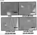 Fig. 174 - Systems and methods for treating alpha 1-antitrypsin (A1AT) deficiency