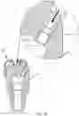 Fig. 04 - Replaceable nozzle for drilling bit