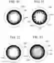 Fig. 08 - CONTACT LENS WITH IMPROVED, MULTIPLE AND INTEGRATED EFFECTS