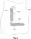 Fig. 04 - Implanting method and apparatus