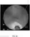 Fig. 05 - Deformed grid based intra-operative system and method of use