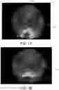 Fig. 08 - Deformed grid based intra-operative system and method of use