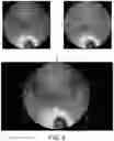 Fig. 10 - Deformed grid based intra-operative system and method of use