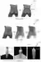 Fig. 15 - Patch splitting for improving video-based point cloud compression performance