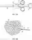Fig. 21 - Cinch ligating assembly