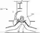 Fig. 01 - Implant fixation devices and methods of using the same