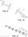 Fig. 06 - Implant fixation devices and methods of using the same