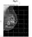 Fig. 04 - System, user interface and method for interactive negative explanation of machine-learning localization models in health care applications