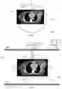 Fig. 02 - Peripheral tumour treatment