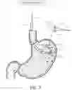 Fig. 08 - Medical ablation devices and methods