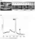 Fig. 02 - Low-temperature plasma catheter for less-invasive, localized treatment of endocarditis and atherosclerosis