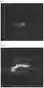Fig. 07 - Low-temperature plasma catheter for less-invasive, localized treatment of endocarditis and atherosclerosis