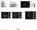 Fig. 14 - TREATMENT OF BONE GROWTH DISORDERS