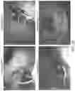 Fig. 10 - TRIGGERABLE HYDROGEL COMPOSITIONS AND RELATED METHODS