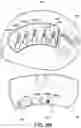 Fig. 17 - Negative pressure wound therapy apparatus with removable panels