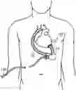Fig. 01 - VENTRICULAR ASSIST BLOOD PUMP
