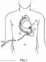 Fig. 02 - VENTRICULAR ASSIST BLOOD PUMP