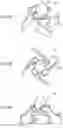 Fig. 05 - VENTRICULAR ASSIST BLOOD PUMP