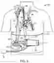 Fig. 06 - VA ECMO with pulmonary artery ventilation