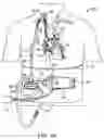 Fig. 07 - VA ECMO with pulmonary artery ventilation