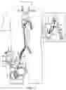 Fig. 08 - VA ECMO with pulmonary artery ventilation